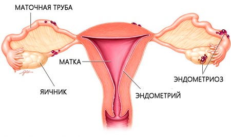 Эндометриоз матки  лечение в Махачкале