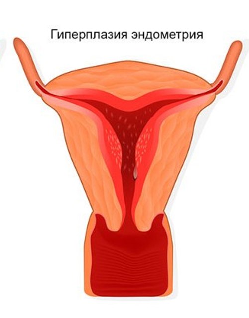 Патология эндометрия в менопаузальном периоде: проявления, диагностика, методы лечения