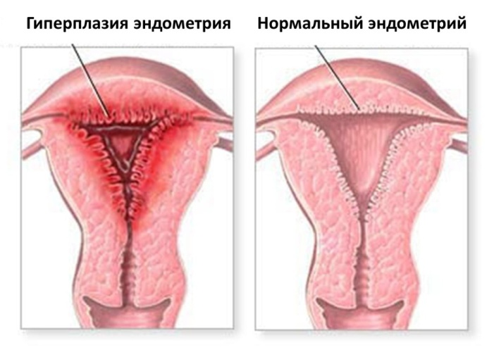 Гиперплазия эндометрия