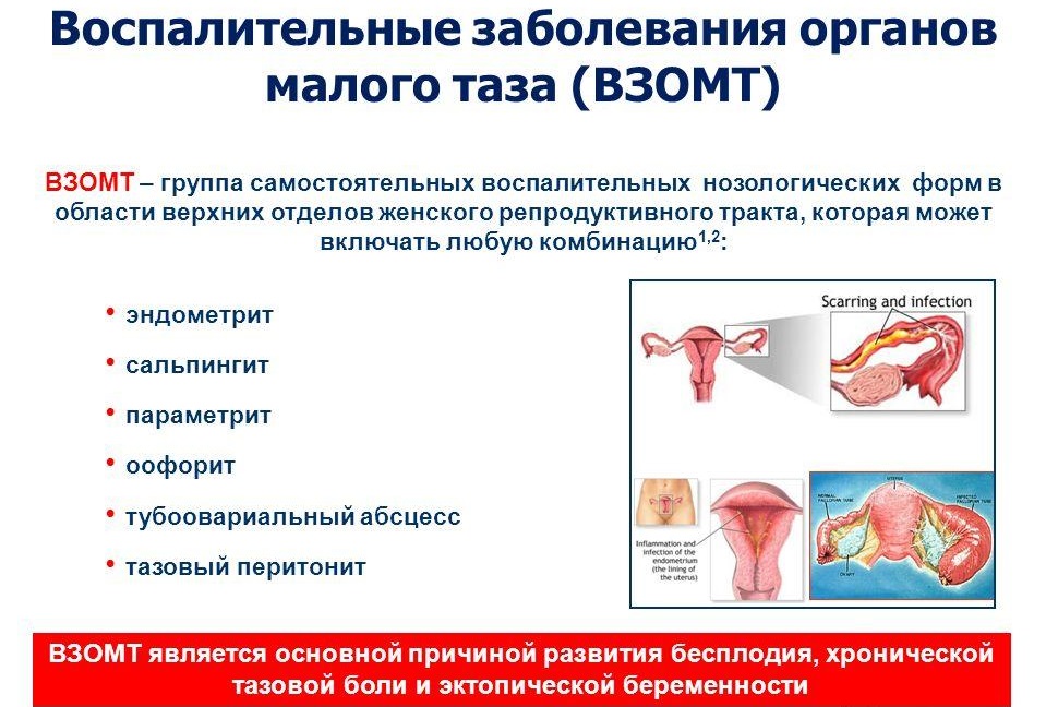 Воспаление органов малого таза у женщин