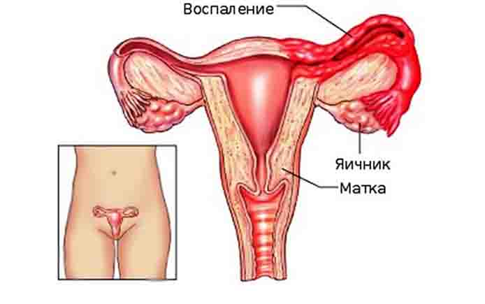 Воспаление придатков и яичников